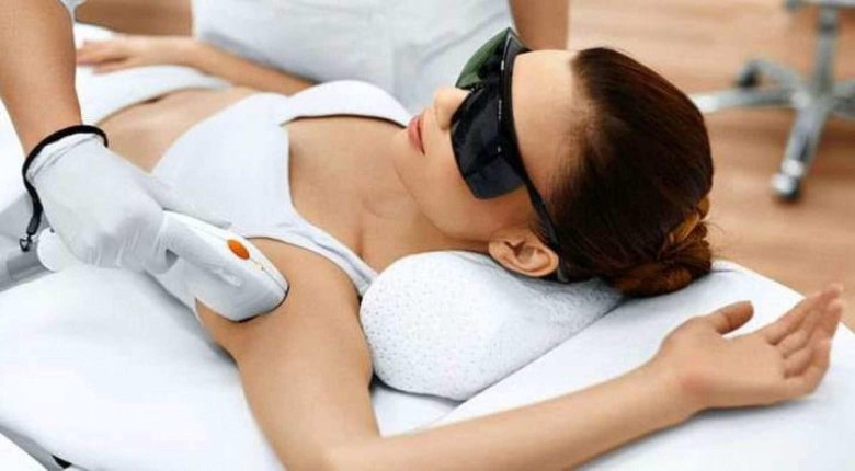 Лазерная эпиляция