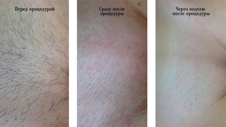 Электроэпиляция глубокого бикини