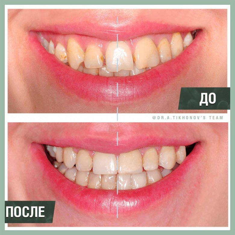 Смещенный верхний ряд зубов