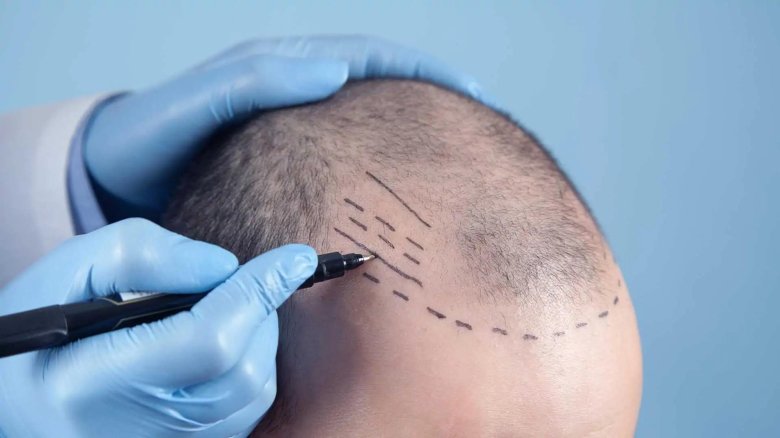 Fue hair transplant