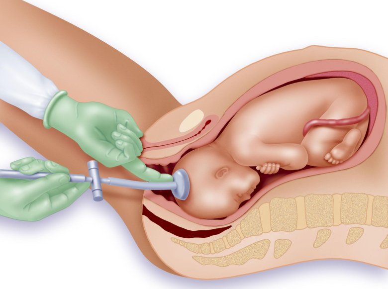 Вакуум экстракция плода